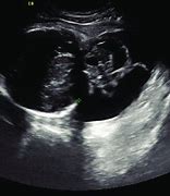 Image result for Encephalocele Ultrasound