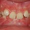 Image result for Correcting Overbite