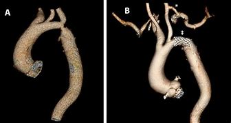 Image result for External Carotid Artery Angiogram