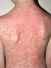 Image result for Antibiotic Allergy Rash