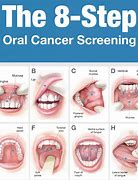 Image result for Diagnosis of Jaw Cancer
