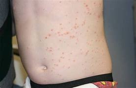 Image result for Bumps On Kids Skin Molluscum