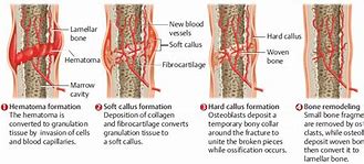 Image result for Bone Fracture Healing