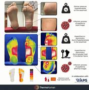 Image result for HPV Virus On Feet