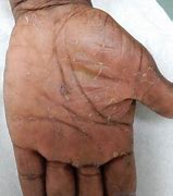 Image result for Syphilis Rash On Hands