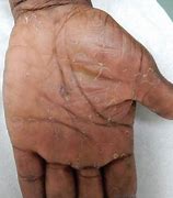 Image result for Syphilis Hands