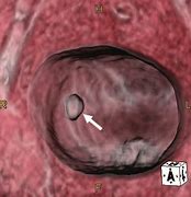 Image result for Pink Urine Bladder Tumor