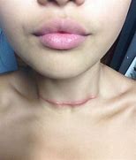 Image result for Thyroid Removal Scar