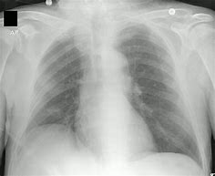 Image result for PICC Line Chest