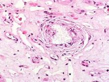 Image result for Urate Nephropathy