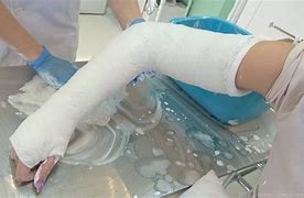 Image result for Dual Long Arm Cast