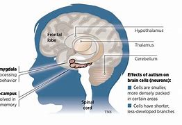 Image result for Autism Spectrum Disorder Brain