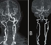 Image result for CT Carotid Angiogram
