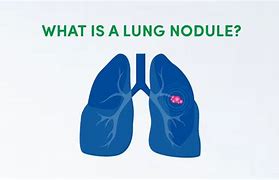 Image result for What Are Nodules in the Lungs