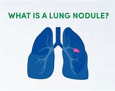 Image result for 1 Cm Lung Nodule