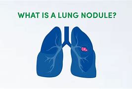 Image result for 2 Cm Nodule On Lung