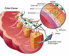 Image result for Colon Cancer Tumor
