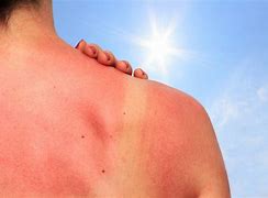 Image result for Sunburn On Shoulders