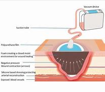 Image result for Wound Vac Drainage