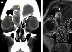 Image result for Sinonasal Tumors