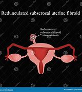 Image result for Pedunculated Uterine Fibroid