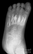 Image result for Toller Broken Foot