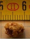 Image result for How Big Is 5 mm Kidney Stone