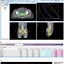 Image result for 3D-CRT Bracitheraphy