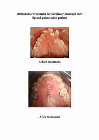 Image result for Collapsed Foot Arch Surgery
