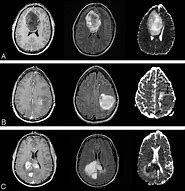 Image result for Brain Tumor CT Scan