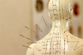 Image result for Medical Acupuncture