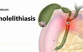 Image result for Physical Activity and Exercise in Cholilithiasis