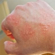 Image result for Allergy Hives