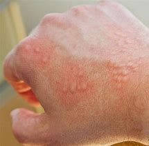 Image result for Allergic Skin Disease