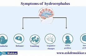 Image result for Hydrocephalus Signs and Syptoms Cartoon Images