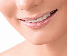 Image result for Invisible Line Dental