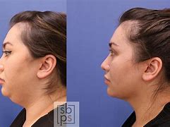 Image result for Laser Lipo Chin