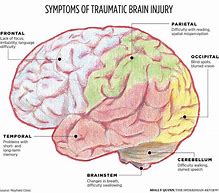 Image result for Trauma Brain vs Normal Brain
