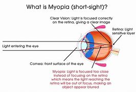 short-sighted 的图像结果