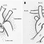 Image result for Carotid Artery Surgery Procedure