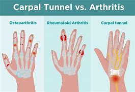 Image result for Hand and Wrist Arthritis