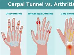 Image result for Arthritis in Wrist