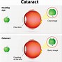 Image result for Cataract Eye Surgery Cartoons