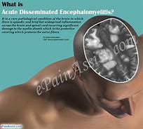 Image result for encefalomielitis