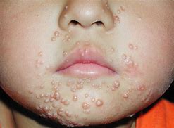 Image result for Molluscum On Lips