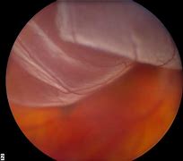 Image result for Detached Retina Vision Example