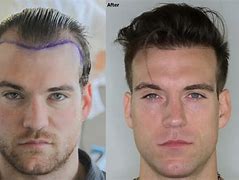 Image result for 3500 Grafts Hair Transplant