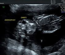 Image result for Anencephaly Fetal Ultrasound