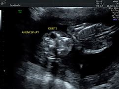 Image result for Ancephaly On 20 Week 3D Ultrasound