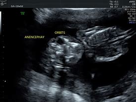 Image result for Anencephaly Ultrasound Images 3D
